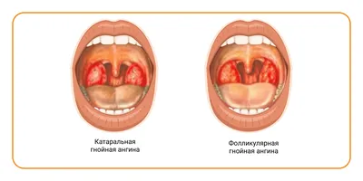 Гнойная ангина