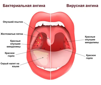 Катаральная ангина — статьи от отоларинголога в Москве