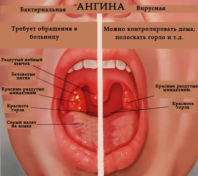 Фолликулярная ангина, лечение и симптомы, заразна ли фолликулярная ангина,  как передается - блог Furasol®