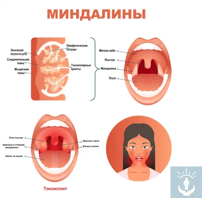 Ангина: причины, и симптомы, лечение, диагностика и профилактика ангины