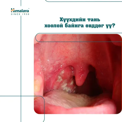 Ангина у взрослых - статьи от компании Еламед