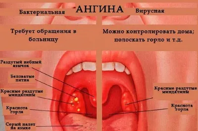 Ангина - что это за болезнь? | CorSwiss