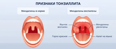 Лечение ангины: препараты для лечения в домашних условиях - статьи от  компании Еламед