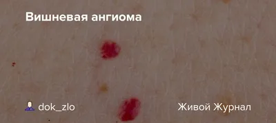 Кавернозные мальформации (каверномы, ангиомы и гемангиомы) - возможности  лечения, эффективность различных методов