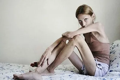 Психанула: пышная девушка начала худеть, но все обернулось анорексией (Фото)