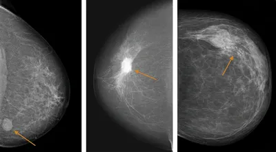 7 сигналов, что нужно бежать к маммологу, или Как избежать рака груди: 25  октября 2019, 18:38 - новости на Tengrinews.kz