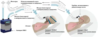Аппараты искусственной вентиляции легких - купить в СПб. Компания  «Лабораторный медицинский продукт»