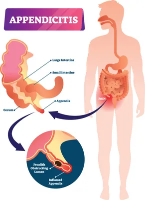 Про аппендицит слышали все, но не все знают, что это заболевание может  привести к серьезным последствиям и даже летальному.. | ВКонтакте