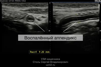 Признаки аппендицита и его лабораторная диагностика