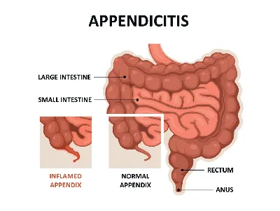 Заболевания червеобразного отростка — (клиники Di Центр)