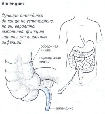 Морфология острого аппендицита