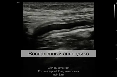 Правда или нет: Если есть семечки, заработаешь аппендицит. Ответ врача