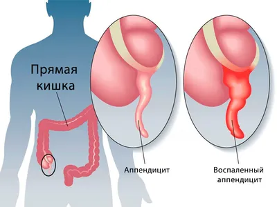 Хирург Павленко Тарас Олегович - Диагностика, операция, результат. Острый  флегмонозно-гангренозный аппендицит. | Facebook