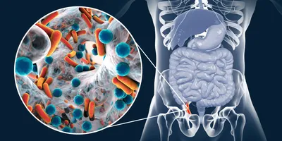 Острый аппендицит: симптомы, причины, диагностика и лечение