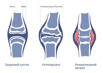 Ревматоидный артрит — что это, симптомы, как лечить | Купрум
