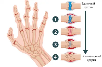Ревматоидный артрит рук: лечение и симптомы - статьи от компании Еламед