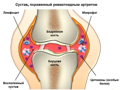 Ревматоидный артрит: симптомы, диагностика и лечение в Киеве