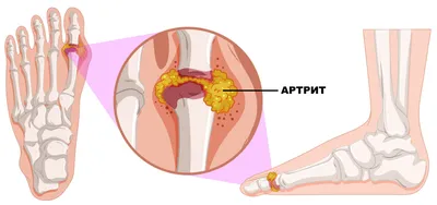 Артрит: причины, симптомы, диагностика и лечение | МЦ Rubinko