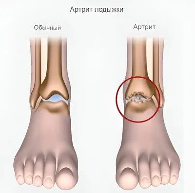 Псориатический артрит: причины, симптомы и лечение в Москве