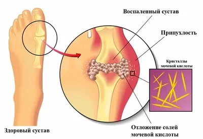 Артрит | Санаторий Боржава