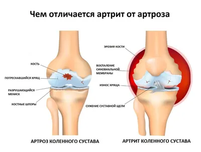 Ревматоидный артрит