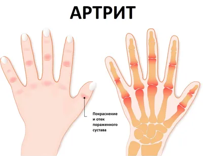 Артрит — лечение и симптомы заболевания, причины появления, диагностика,  какой врач лечит