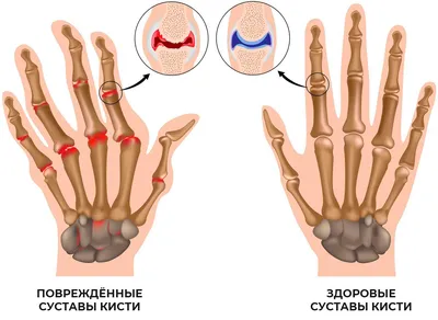 Артрит: причины, симптомы и лечение