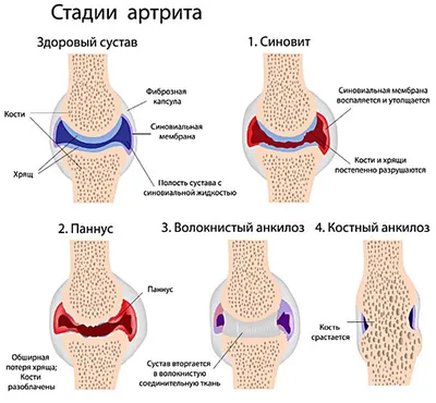 Артрит - причины развития заболевания, симптомы, диагностика и лечение