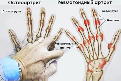 Лечение ревматоидного артрита в Германии, цена в клинике Нордвест