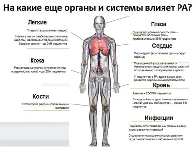 Лечение ревматоидного артрита в ЦБС - избавляем от боли! Препараты  Голимумаб, Инфликсимаб, Ритуксимаб