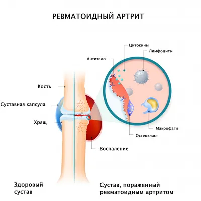 Артрит - причины развития заболевания, симптомы, диагностика и лечение