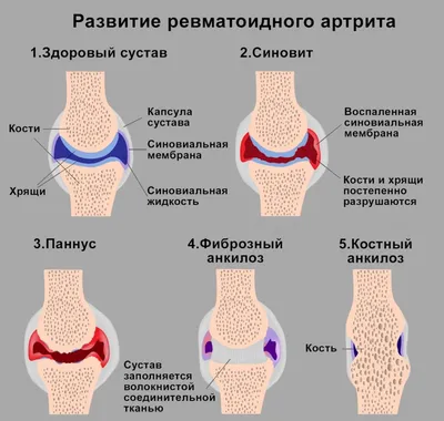 Ревматоидный артрит - БСМП Гродно