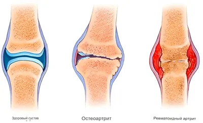 Артроз и артрит - боли в суставах, лечение и симптомы
