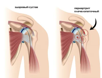 КДЦ \"Медицина\" - 👓Хочется отметить, что симптомы ревматоидного артрита  узнаваемы: 🔹Первоначально ревматоидный артрит обычно поражает мелкие  суставы (пальцы, запястья рук). 🔹При ревматоидном артрите суставы чаще  всего поражаются симметрично (например ...