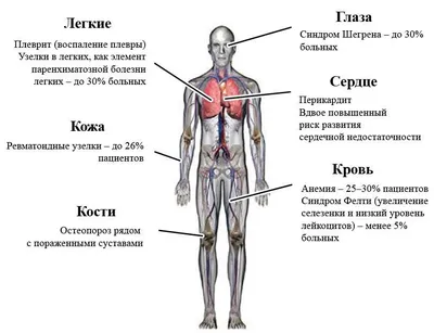 Псориатический артрит: причины, симптомы и лечение в Москве