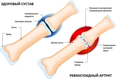 Ревматоидный артрит: симптомы, диагностика, лечение