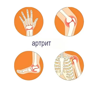 Хронический артрит: симптомы и лечение