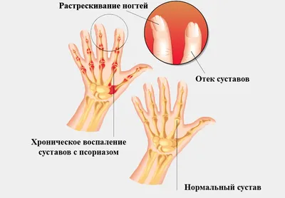 Артрит суставов: симптомы, диагностика, лечение - статьи от компании Еламед