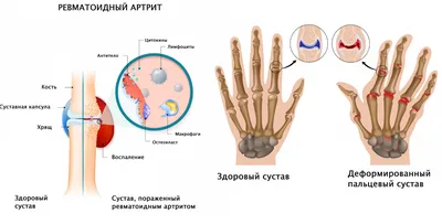 Артрит: виды, симптомы, профилактика, лечение заболевания