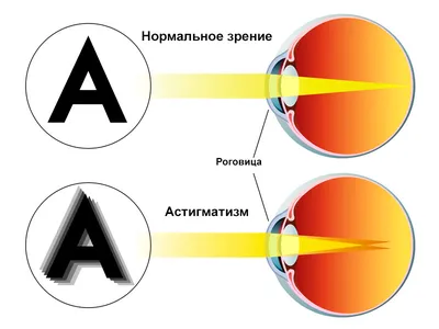 Астигматизм сложный, простой, смешанный