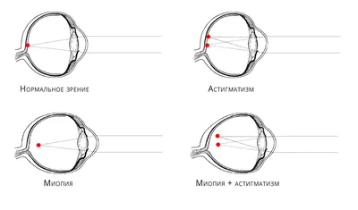 Особенности лечения близорукости, дальнозоркости и астигматизма | World  Vision Clinic