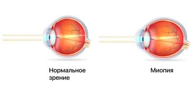 Коррекция (лечение) зрения при сложном миопическом астигматизме