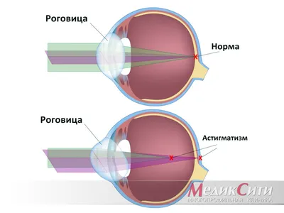 Астигматизм: причины и лечение. Коррекция астигматизма