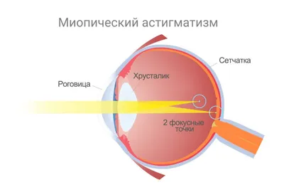 Миопический астигматизм ‒ что это такое и как лечить