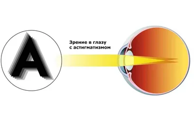 Астигматизм – Центр лазерной микрохирургии глаза