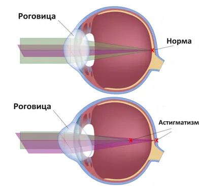 Астигматизм глаз: причины, симптомы, диагностика, лазерное лечение,  профилактика