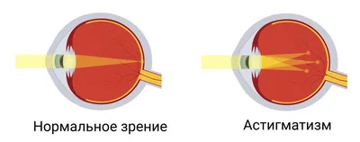 Смешанный астигматизм ‒ причины и коррекция патологии - ЕврООптика