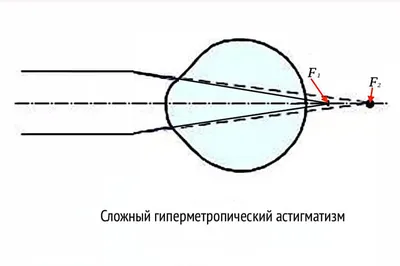 Лечится ли астигматизм или, как исправить астигматизм у взрослых? - Методы  лечения