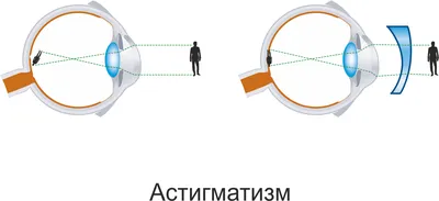 Сложный гиперметропический астигматизм обоих глаз, лечение -  Офтальмологический центр Ирис