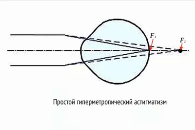 Астигматизм - офтальмологическая клиника \"Визус\" в Пскове